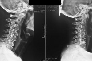 dolor cervical