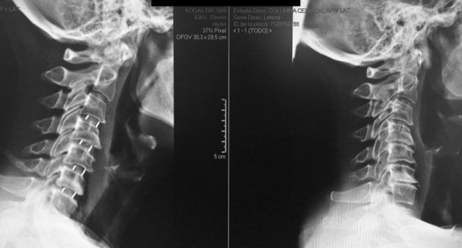 dolor cervical