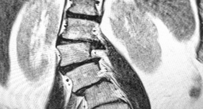 dolor lumbar