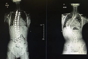 escoliosis1