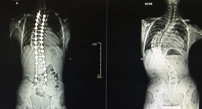 escoliosis1
